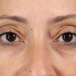 Blepharoplasty (Eyelid Surgery) Before & After Patient #4626