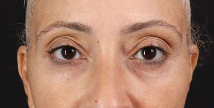 Blepharoplasty (Eyelid Surgery) Before & After Patient #4626