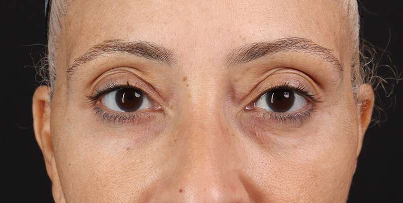 Blepharoplasty (Eyelid Surgery) Before & After Patient #4626