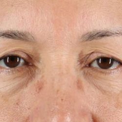 Blepharoplasty (Eyelid Surgery) Before & After Patient #4629