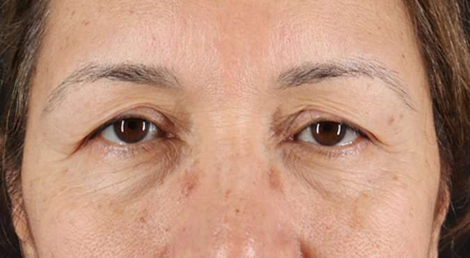 Blepharoplasty (Eyelid Surgery) Before & After Patient #4629
