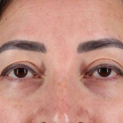 Blepharoplasty (Eyelid Surgery) Before & After Patient #4632