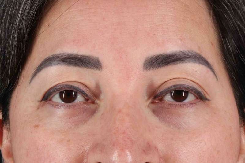 Blepharoplasty (Eyelid Surgery) Before & After Patient #4632
