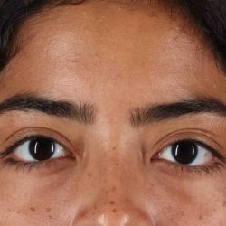 Blepharoplasty (Eyelid Surgery) Before & After Patient #4635