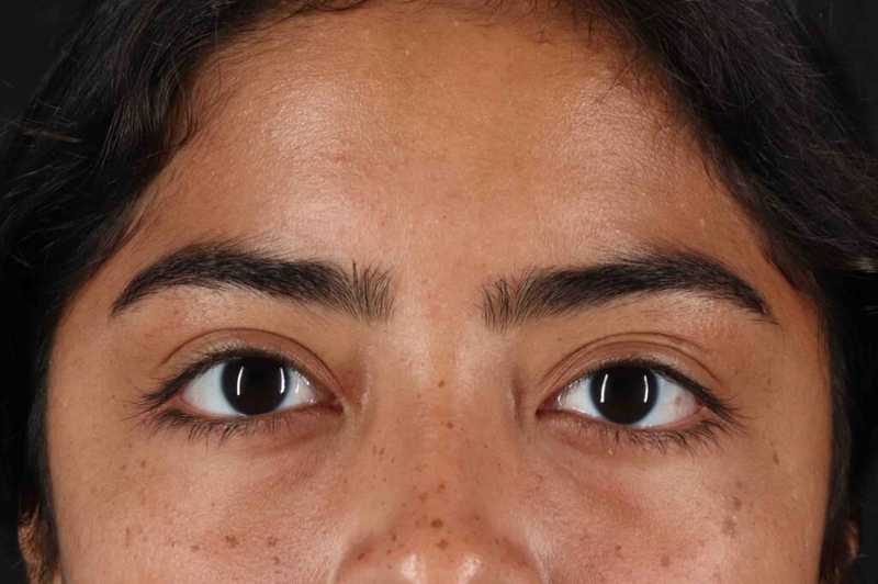 Blepharoplasty (Eyelid Surgery) Before & After Patient #4635
