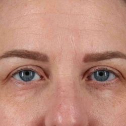 Blepharoplasty (Eyelid Surgery) Before & After Patient #4638