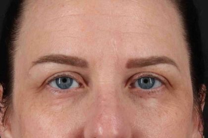 Blepharoplasty (Eyelid Surgery) Before & After Patient #4638