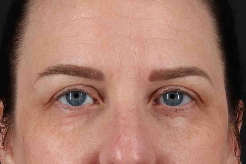 Blepharoplasty (Eyelid Surgery) Before & After Patient #4638