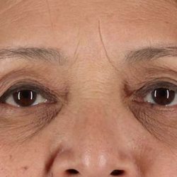 Blepharoplasty (Eyelid Surgery) Before & After Patient #4649