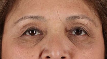 Blepharoplasty (Eyelid Surgery) Before & After Patient #4649