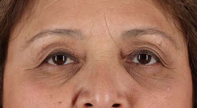 Blepharoplasty (Eyelid Surgery) Before & After Patient #4649