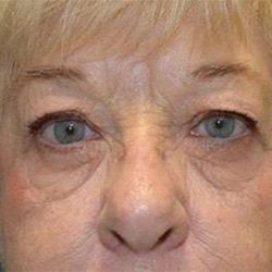 Brow Lift Before & After Patient #4652
