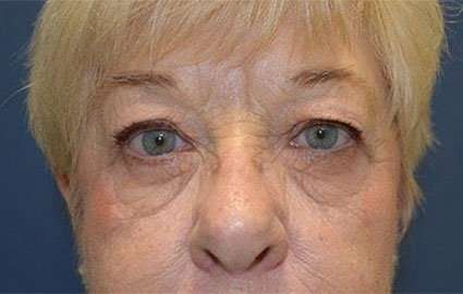 Brow Lift Before & After Patient #4652