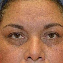 Brow Lift Before & After Patient #4655