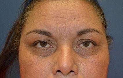 Brow Lift Before & After Patient #4655