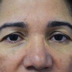 Brow Lift Before & After Patient #4658