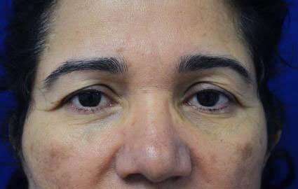 Brow Lift Before & After Patient #4658