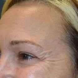 Brow Lift Before & After Patient #4661