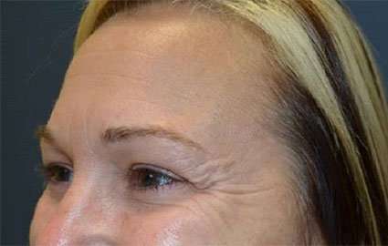 Brow Lift Before & After Patient #4661