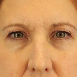 Brow Lift Before & After Patient #4672