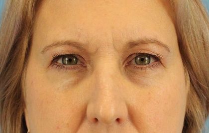 Brow Lift Before & After Patient #4672