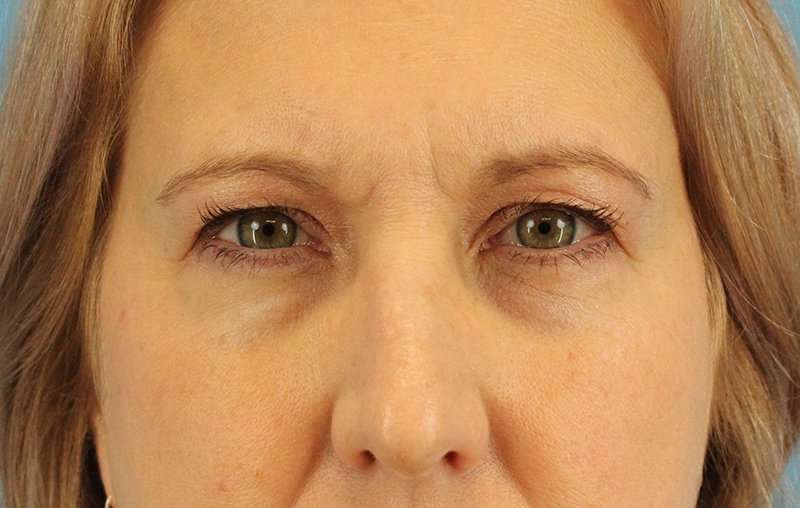 Brow Lift Before & After Patient #4672