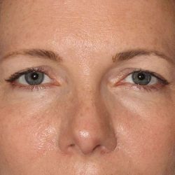 Brow Lift Before & After Patient #4679