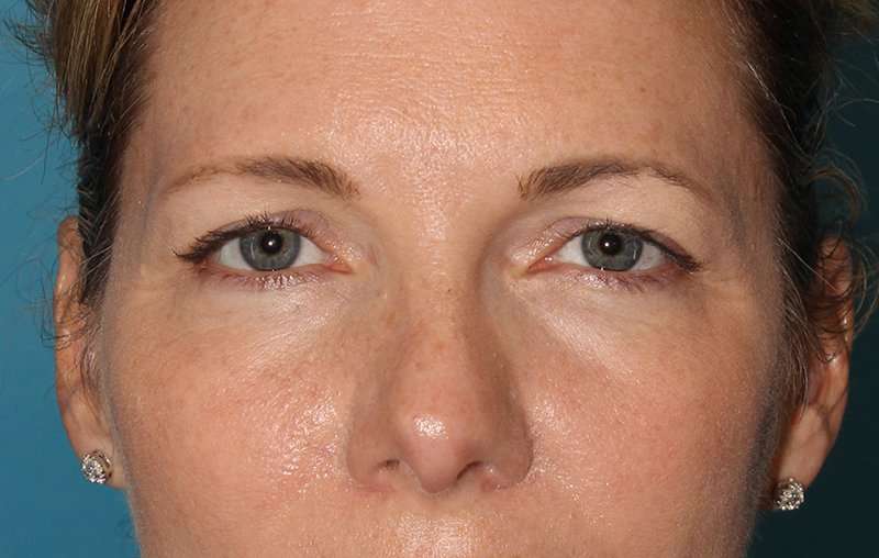 Brow Lift Before & After Patient #4679