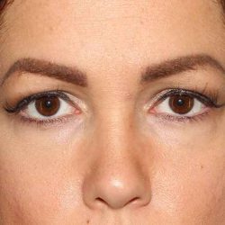 Brow Lift Before & After Patient #4690
