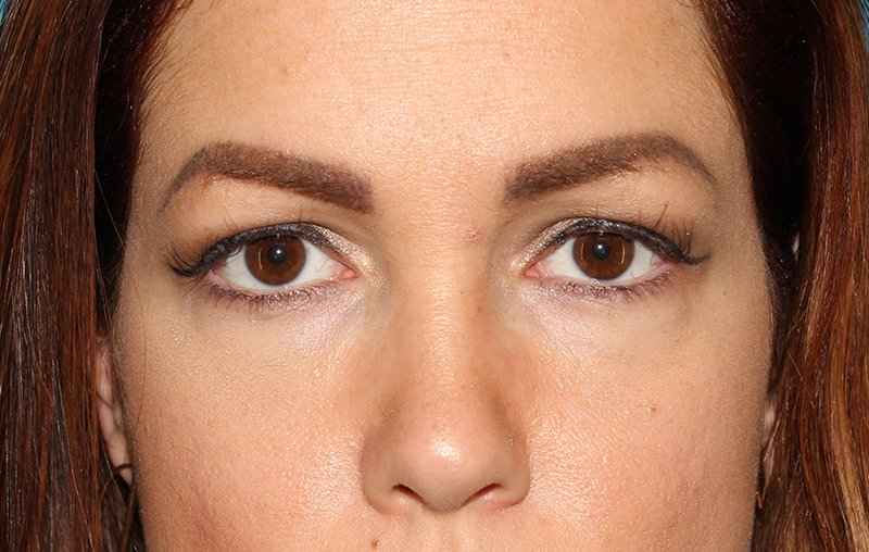 Brow Lift Before & After Patient #4690