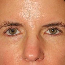 Brow Lift Before & After Patient #4697