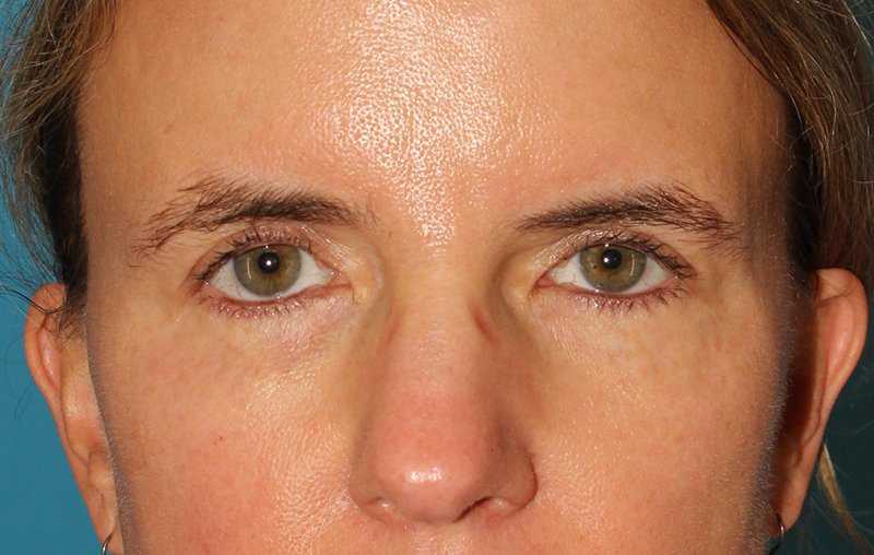 Brow Lift Before & After Patient #4697