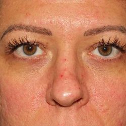 Brow Lift Before & After Patient #4700