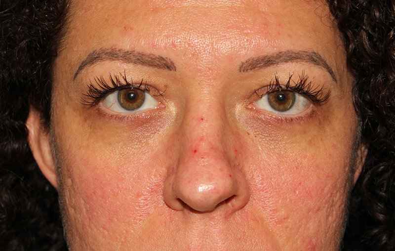 Brow Lift Before & After Patient #4700