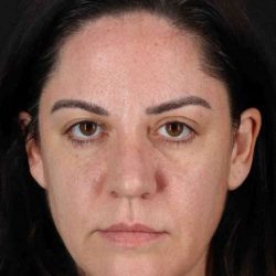 Brow Lift Before & After Patient #4733