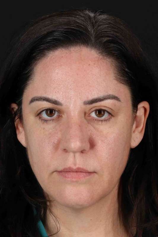 Brow Lift Before & After Patient #4733