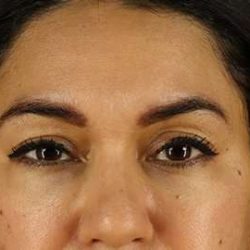 Brow Lift Before & After Patient #4744