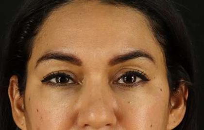 Brow Lift Before & After Patient #4744