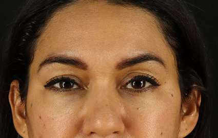 Brow Lift Before & After Patient #4744