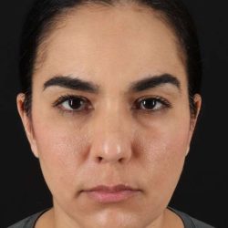 Brow Lift Before & After Patient #4755
