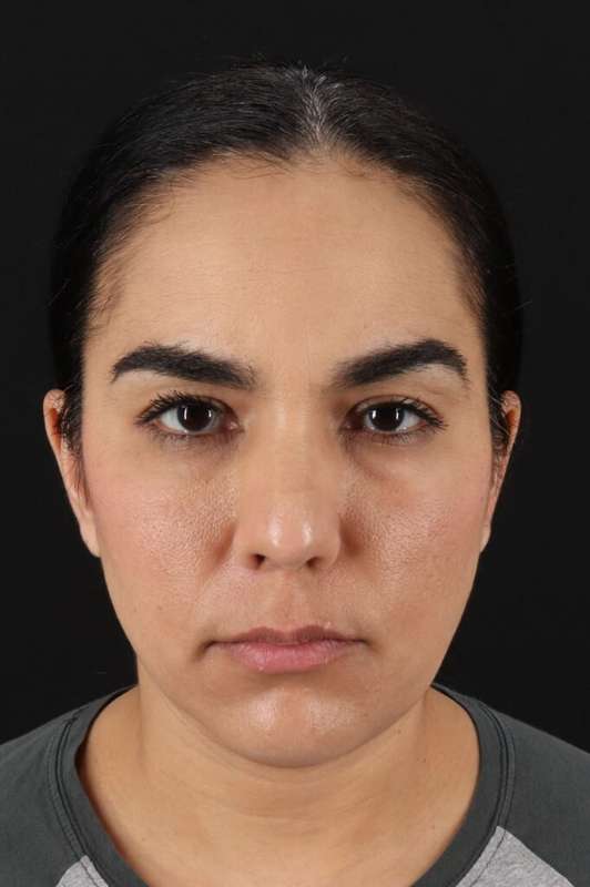 Brow Lift Before & After Patient #4755