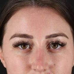 Brow Lift Before & After Patient #4766