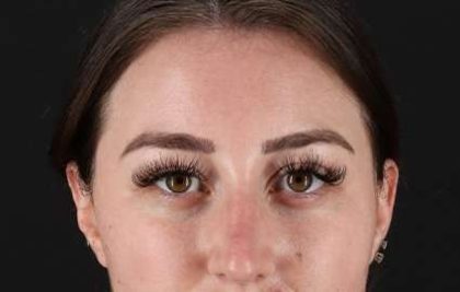 Brow Lift Before & After Patient #4766