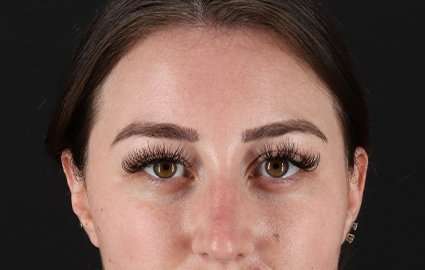 Brow Lift Before & After Patient #4766