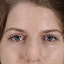 Brow Lift Before & After Patient #4777