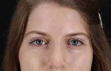Brow Lift Before & After Patient #4777