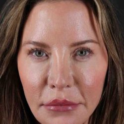 Brow Lift Before & After Patient #4788