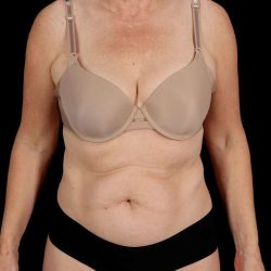 Abdominoplasty (Tummy Tuck) Before & After Patient #1029