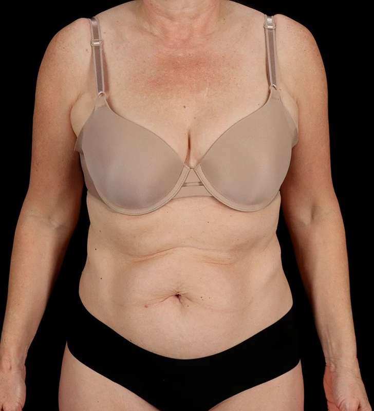 Abdominoplasty (Tummy Tuck) Before & After Patient #1029