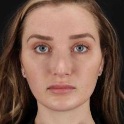 Brow Lift Before & After Patient #4799